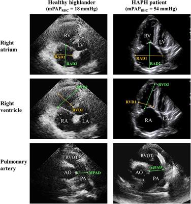 A novel clinical prediction scoring system of high-altitude pulmonary hypertension